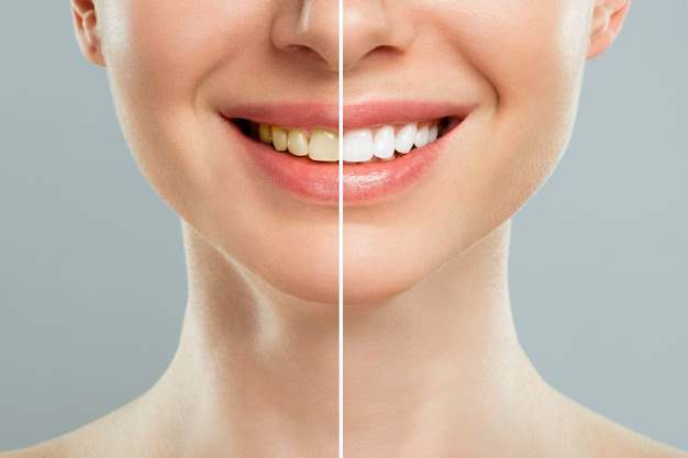 teeth-whitening-3